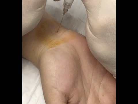 Pain after steroid injection in foot