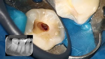 The Wand  STA Single Tooth Anesthesia