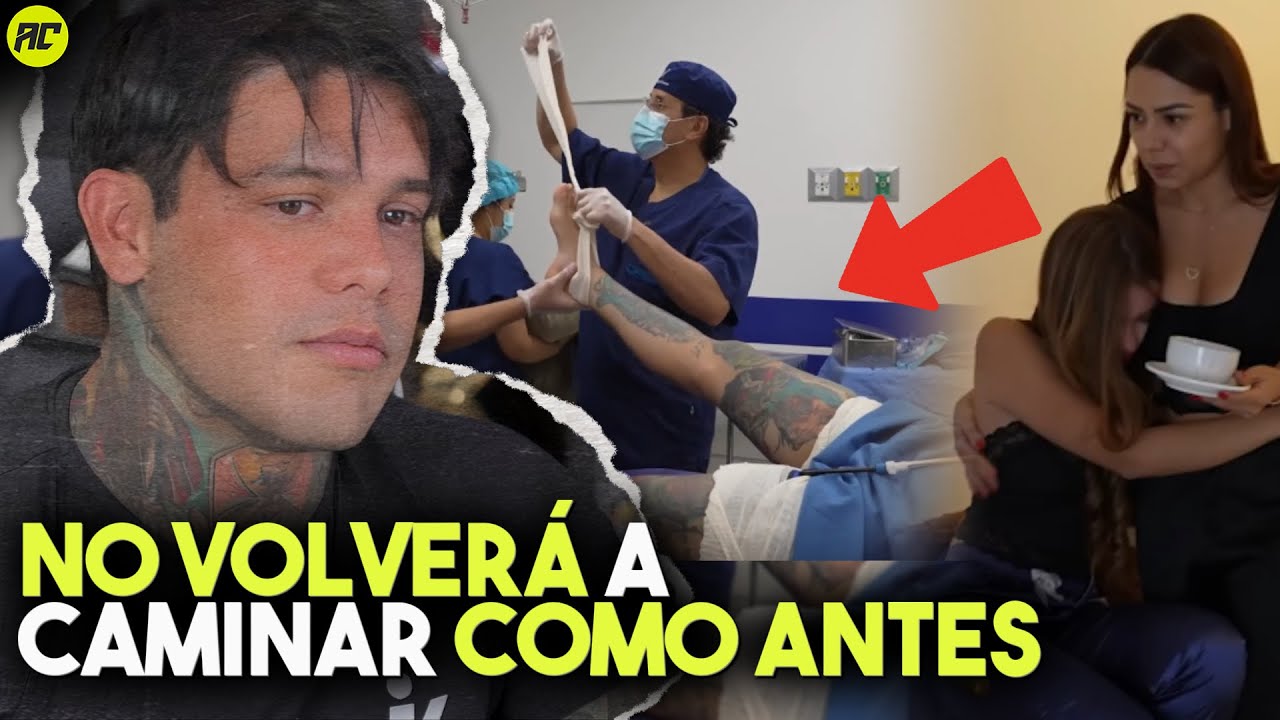 Yeferson Cossio Ya no Volverá a Caminar como Antes por su Cirugía de Alargamiento de Piernas.