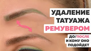 Удаление татуажа ремувером. Кому подойдет и как выглядит татуаж после удаления ремувером ДО/ПОСЛЕ