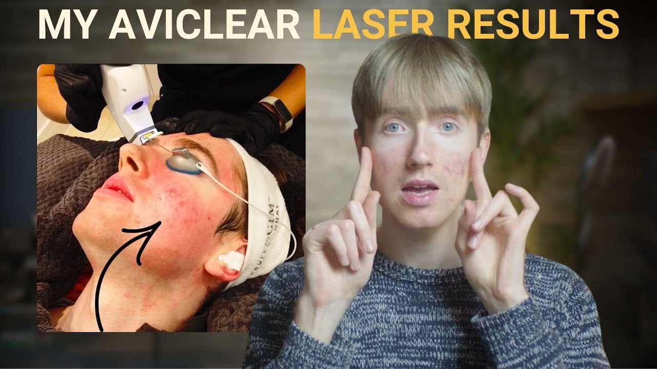 My AviClear Laser Experience | Before and After Results So Far