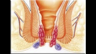 ★Как быстро вылечить геморрой. 10 простых, но эффективных методов ★Как быстро вылечить геморрой. 10 простых, но эффективных методов