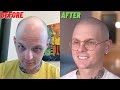 He came from SWEDEN to NYC for Scalp Micropigmentation