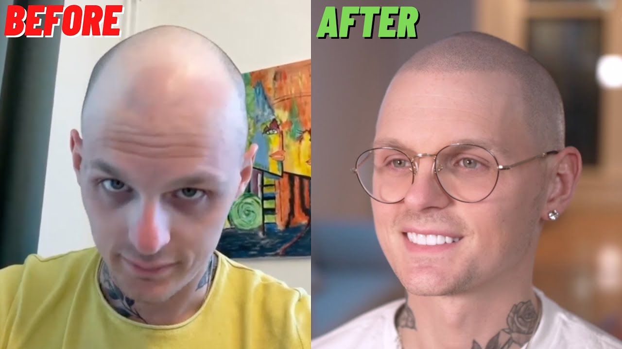 He came from SWEDEN to NYC for Scalp Micropigmentation