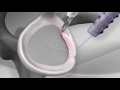 Knotless Shoulder Labral Repair with Arthrex® PushLock®