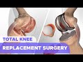 Total knee replacement surgery knee arthroplasty