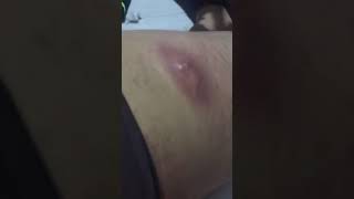 Big cyst explosion