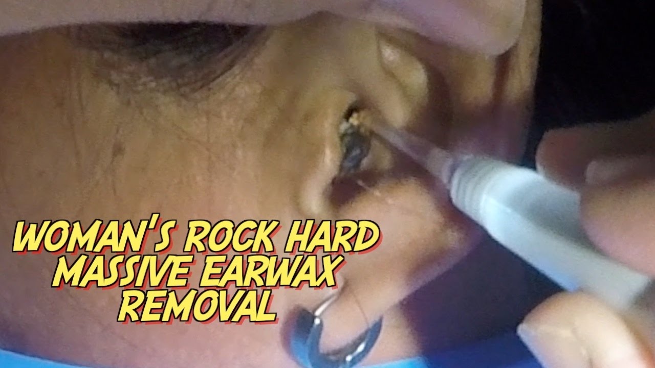 Woman's Rock Hard Massive Earwax Removal YouTube