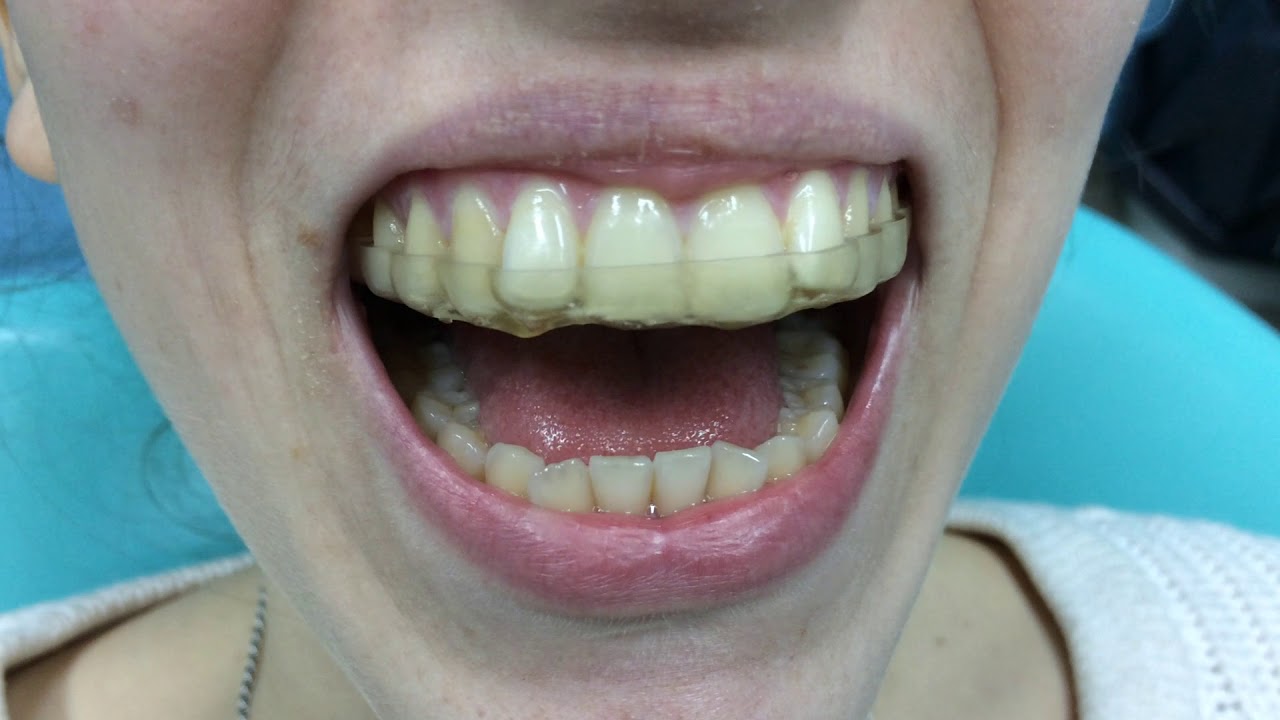 CERIK3D - video 1 - Cerik3D- Placa Neuromiorelajante.