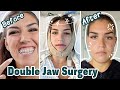 6 DAYS AFTER DOUBLE JAW SURGERY! (Jaw Surgery Recovery Vlog) Ep. 4