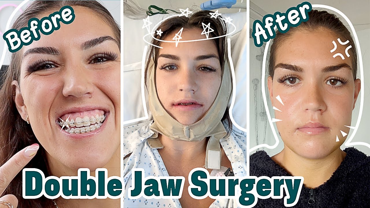 double jaw surgery journey