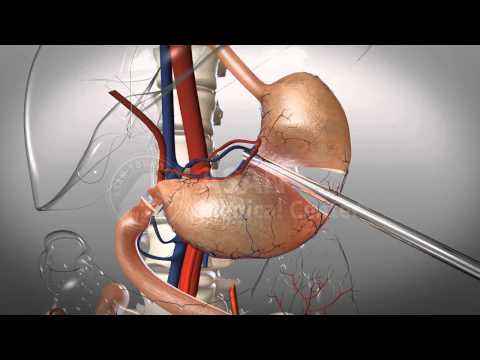 Subtotal Gastrectomy(60%)