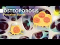 Osteoporosis symptoms and causes - Everything you need to know explained easily