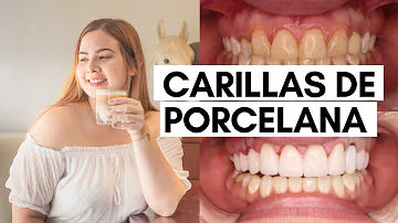 ¿Se puede utilizar pasta de dientes normal con las carillas?