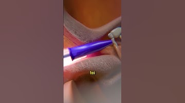 Bất ngờ: Vật lạ kẹt trong tai! 😱#shorts