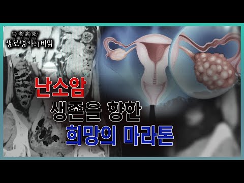 📌방송 하이라이트📌뱃살이 조금 찐 줄 알았는데, 갑자기 난소암 판정을 받는다면? 별다른 증상 없고, 조기 검진법이 없는 난소암의 위험성 (KBS 20230802 방송)