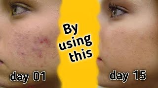 Beauty tips sinhala | how to whiten skin sinhala | skin care sinhala | whitening face pack|සුදුවෙන්න