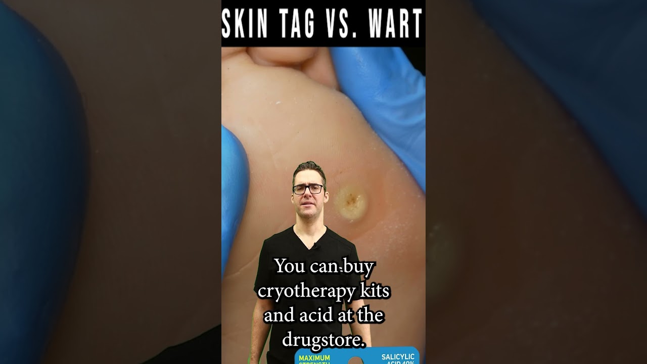 Skin Tag Removal & Wart Removal [How To Get Rid Of Skin Tags & Warts]