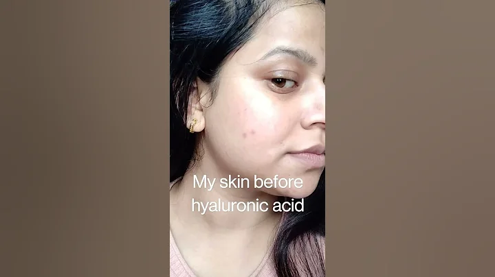 before and after hyaluronic acid #skincareroutine - DayDayNews