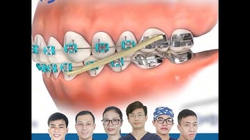 Cách xử lí răng hô, vẩu #Shorts