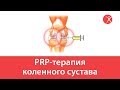 PRP-терапия коленного сустава