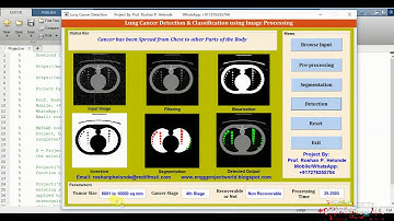 Matlab Source Code for Lung Cancer Stage Detection Using Image Processing
