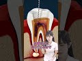 神経まで進行した虫歯の根管治療 #あるある #虫歯治療 #歯医者