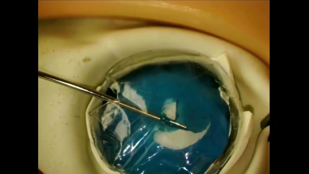 A Cost-Effective Simulation Model for CCC - Supplementary video 6 [ID 378298] - Dove Medical Press