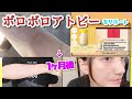 【サプリ】アトピーが悪化⚫︎開き直ってサプリを飲んで経過を記録してみた!