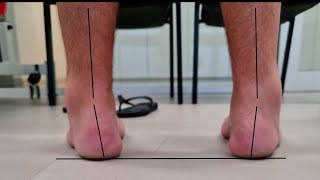 Part I: Assessing the Pes Cavus (high arched) Foot