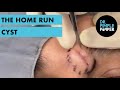 The Home Run Cyst