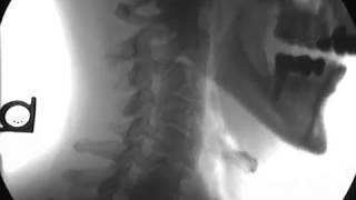 Treating neurologic-like symptoms by addressing cervical spine