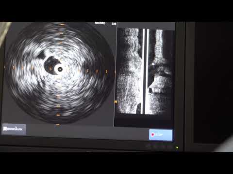 Micah's Venogram Movie Final Draft