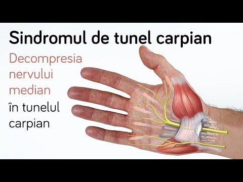 Tratamentul chirurgical in Sindromul de tunel carpian - De ce e necesar?