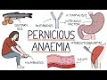 Understanding Pernicious Anaemia: For Students