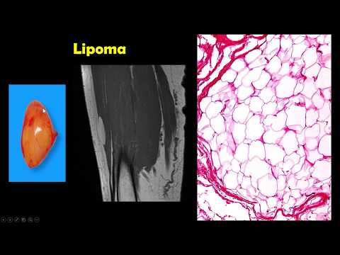 Video: Lipoma - Odstranitev, Alternativno Zdravljenje, Simptomi