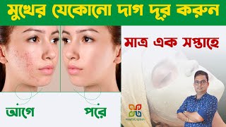 Any spots On Face & its best Natural Home remedies. মুখের যেকোনো দাগ কমার একমাত্র ঘরোয়া চিকিৎসা।