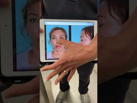 Video thumbnail: Discussing 2-Month Post-Op Ethnic Rhinoplasty Results | Anthony Bared, MD, FACS Miami, FL · Dr. Anthony Bared, M.D - Facial Plastic Surgeon