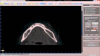 Jaw Segmentation and Definition in Blue Sky Plan