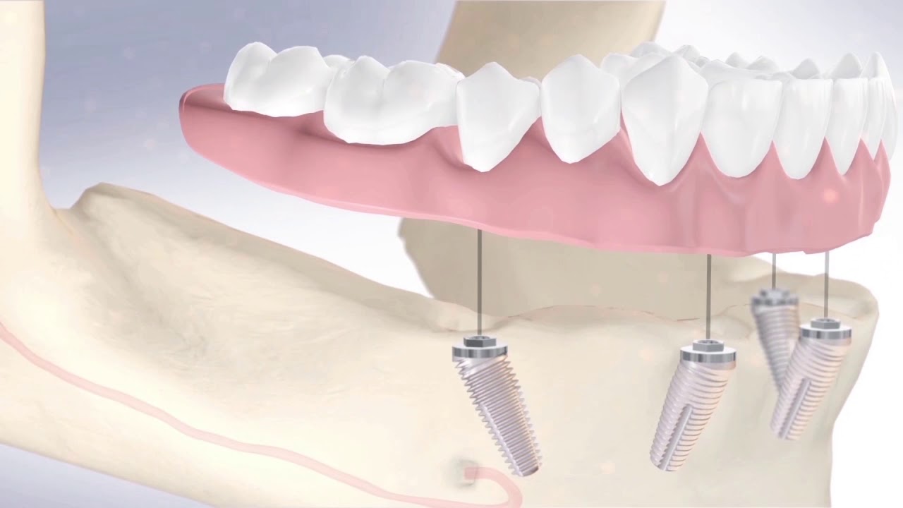Implant CoAxis®, une innovation de Southern Implants YouTube