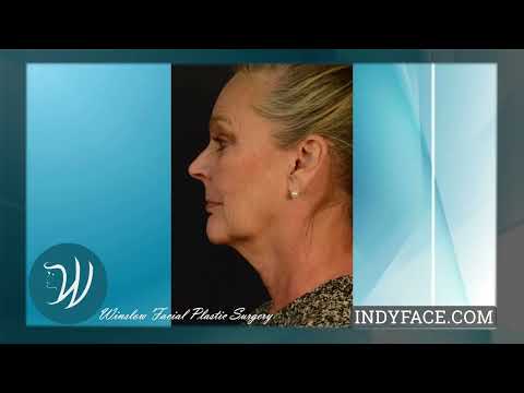 Video thumbnail: Winslow Plastic Surgery Facial Plastic Surgery · Winslow Facial Plastic Surgery