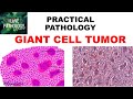 GIANT CELL TUMOR  BONE: Pathogenesis, Clinical features & Morphology