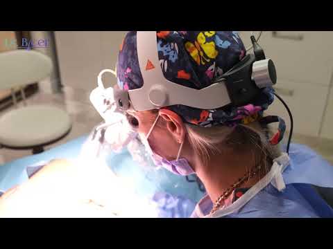 Body Hair Transplant