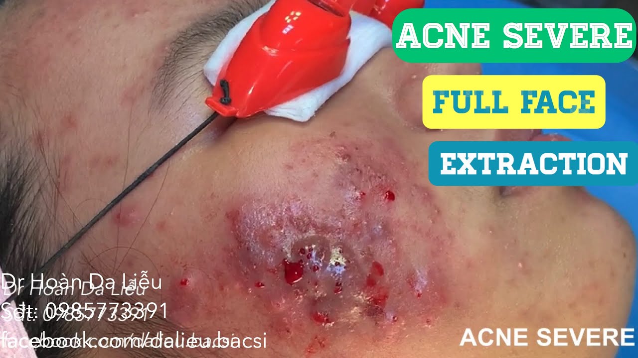 Nặn mụn nhọt áp xe đầy mủ vùng mặt|Squeeze super big... - youtube