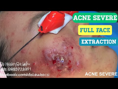 Video Nặn mụn nhọt áp xe đầy mủ vùng mặt|Squeeze super big... - youtube