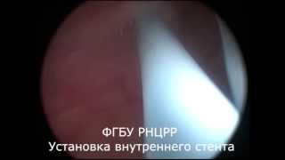 Установка мочеточникового катетер-стента.(ФГБУ РНЦРР МЗ РФ., 2014-09-11T10:18:13.000Z)