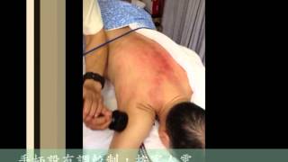 鴻健中醫特色砭石推罐治療
