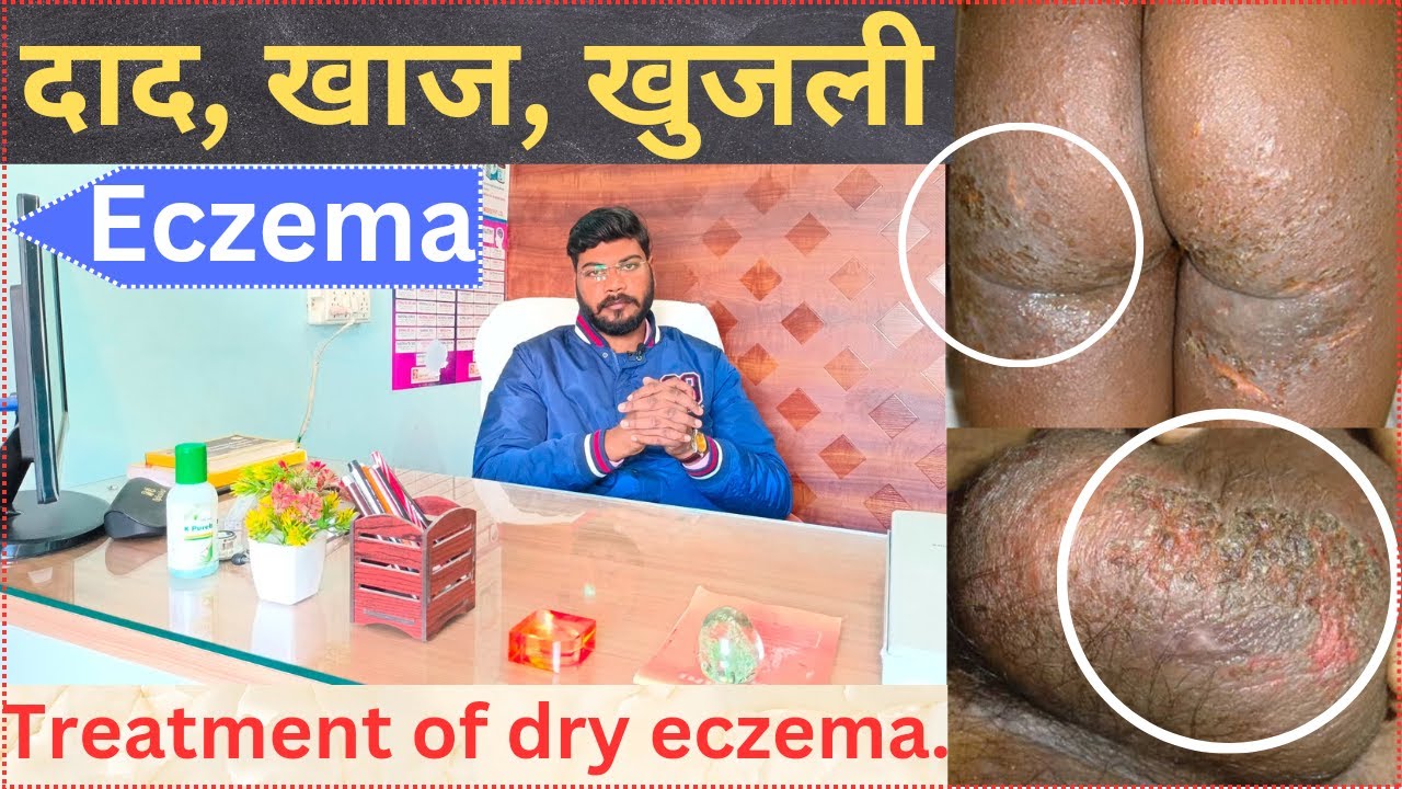 A*dkosh me khujli Treatment of Eczema Dry Eczema YouTube