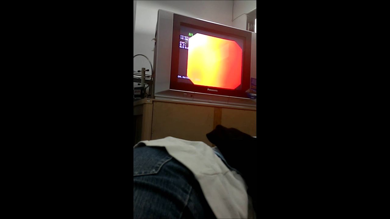 Luka di lambung dan usus Endoskopi YouTube