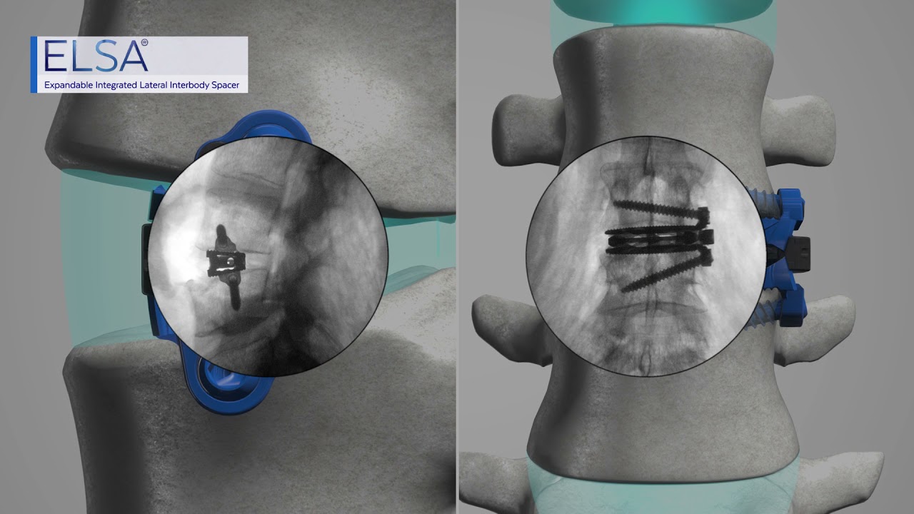 ELSA™ Expandable Lumbar Interbody Spacer
